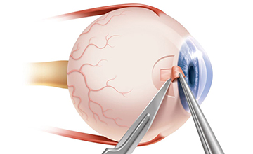 Retina Treatment